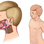 В республике усугубилась ситуация с заболеваемостью свинкой Новости
